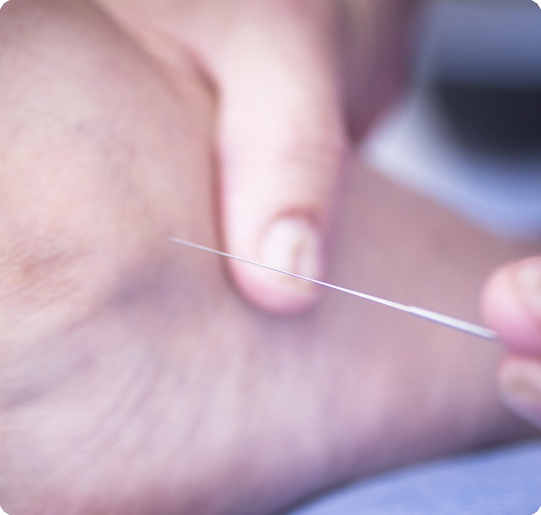 TCM Acupuncture Services | Lifepath Physiotherapy | Chestermere Physiotherapist