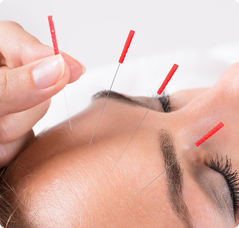 Acupuncture | Lifepath Physiotherapy | Chestermere Physiotherapist